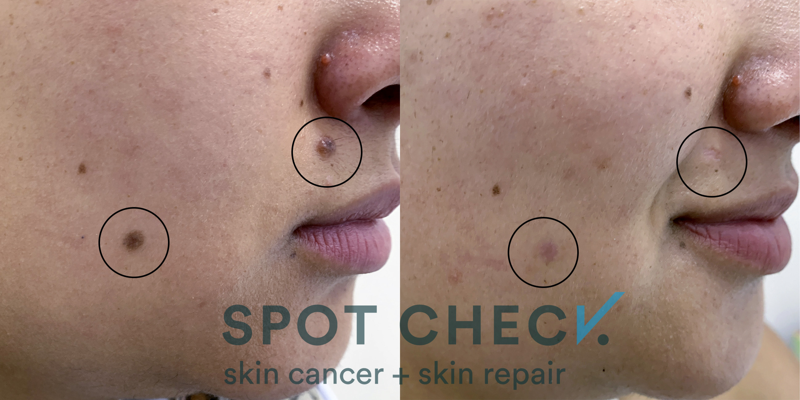 Radiofrequency cosmetic mole and skin lesion removal Spot Check skin